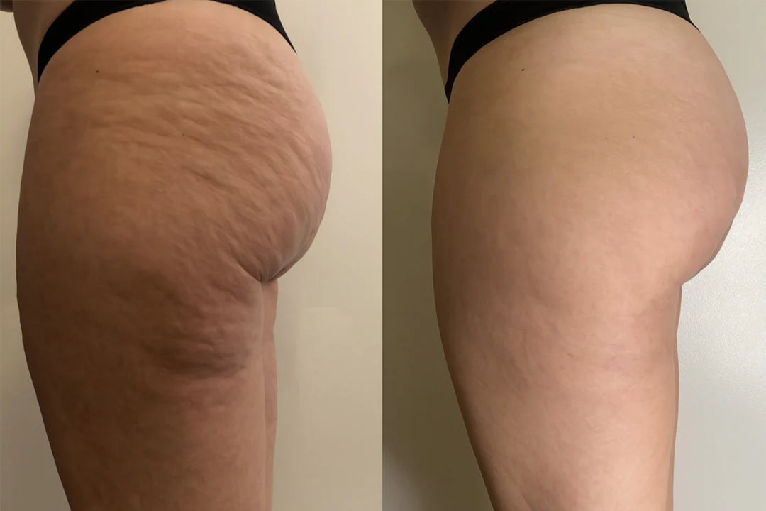 Adeus Cellulite Cream